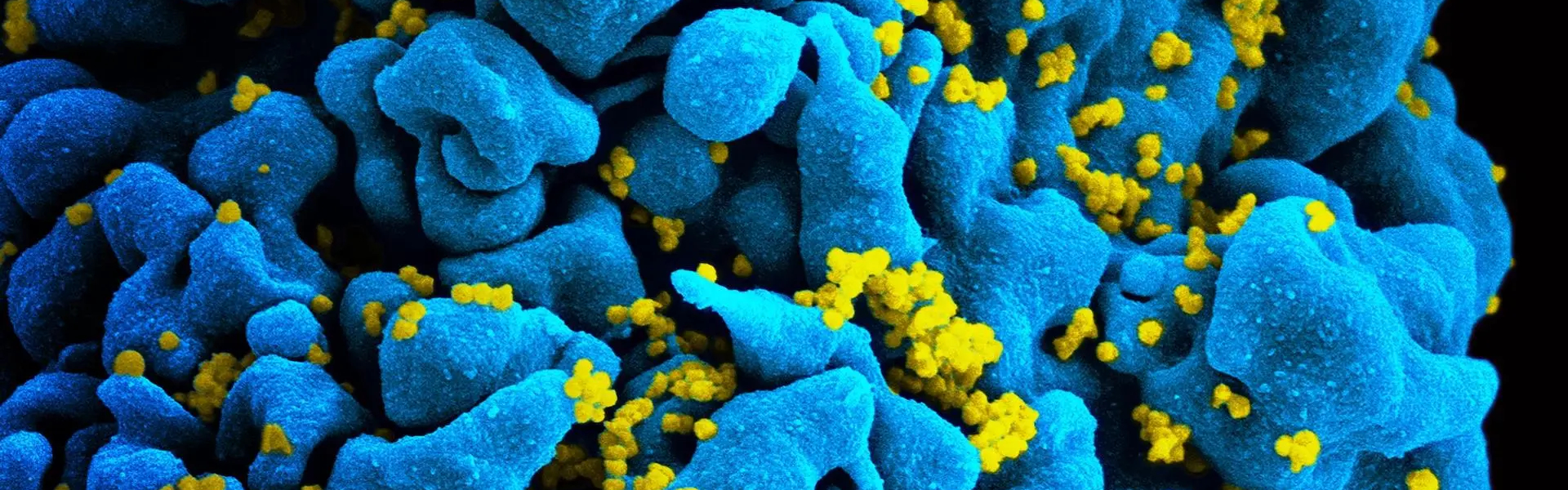 Image of an HIV-infected T-cell