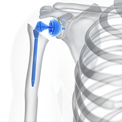 Image of Titanium Shoulder Joint
